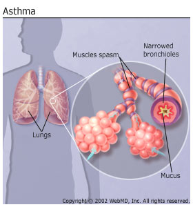 Asthma